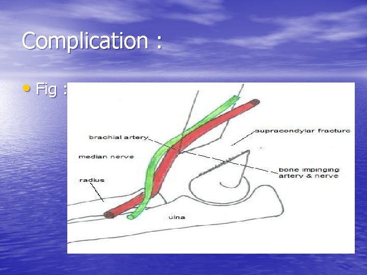 Complication : • Fig : 