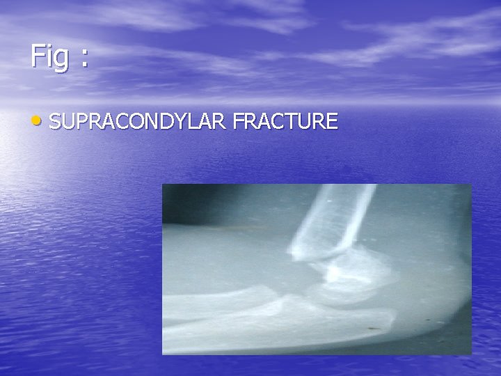 Fig : • SUPRACONDYLAR FRACTURE 