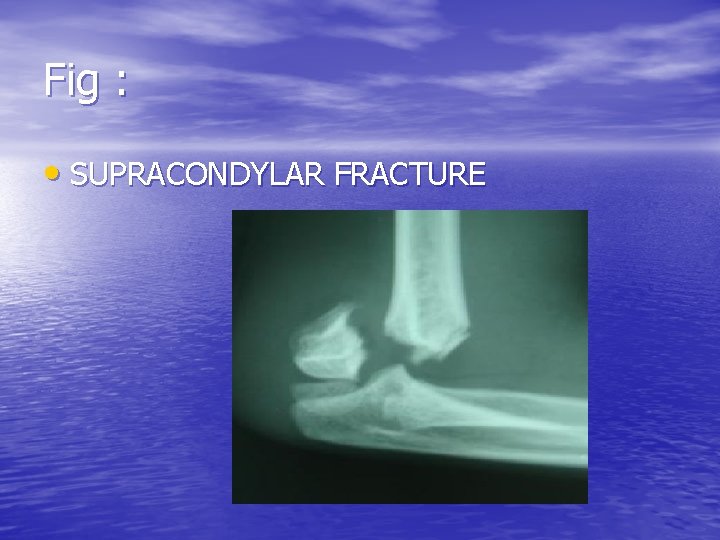 Fig : • SUPRACONDYLAR FRACTURE 