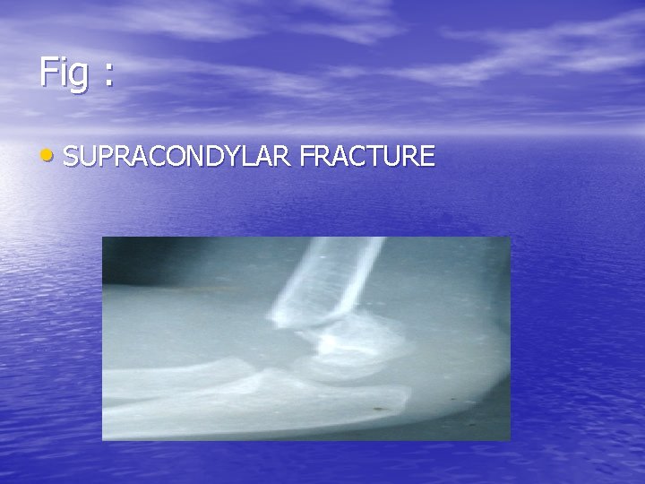 Fig : • SUPRACONDYLAR FRACTURE 