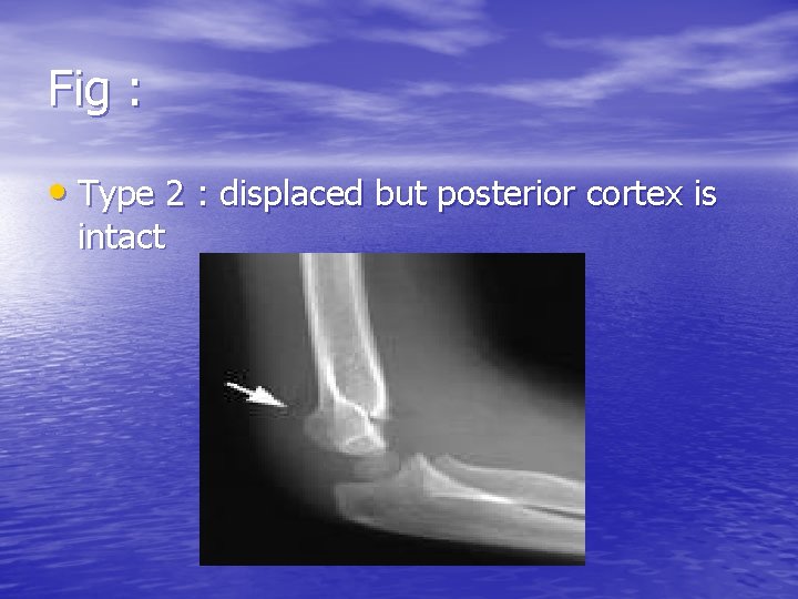 Fig : • Type 2 : displaced but posterior cortex is intact 
