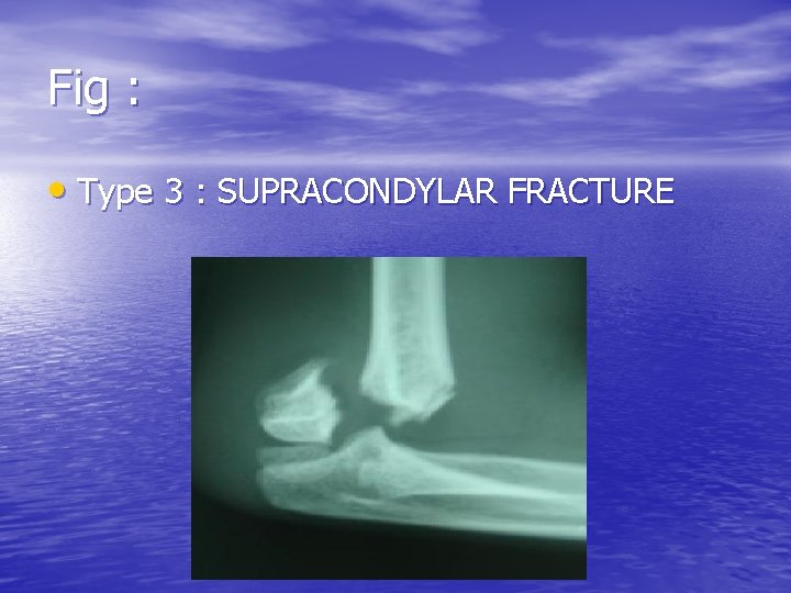 Fig : • Type 3 : SUPRACONDYLAR FRACTURE 