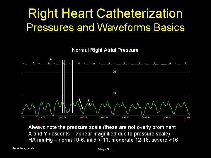 Right Heart Catheterization Pressures and Waveforms Basics Normal Right Atrial Pressure Always note the