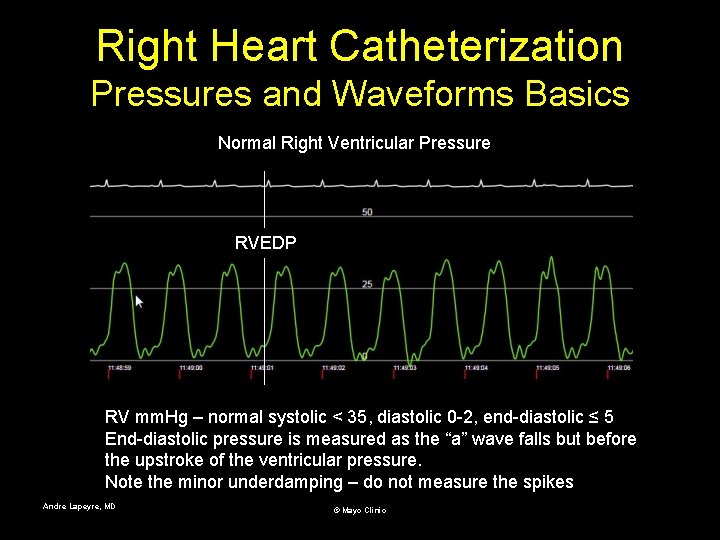 Right Heart Catheterization Pressures and Waveforms Basics Normal Right Ventricular Pressure RVEDP RV mm.