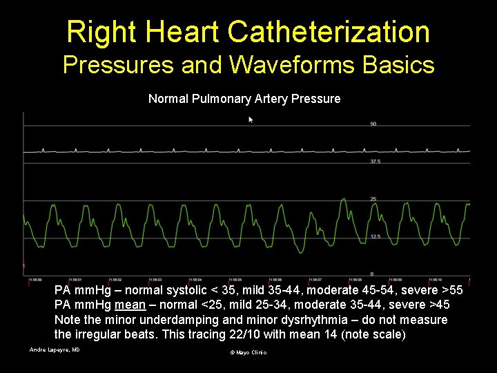 Right Heart Catheterization Pressures and Waveforms Basics Normal Pulmonary Artery Pressure PA mm. Hg