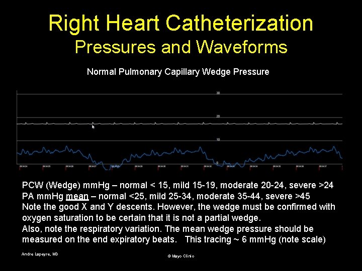 Right Heart Catheterization Pressures and Waveforms Normal Pulmonary Capillary Wedge Pressure PCW (Wedge) mm.