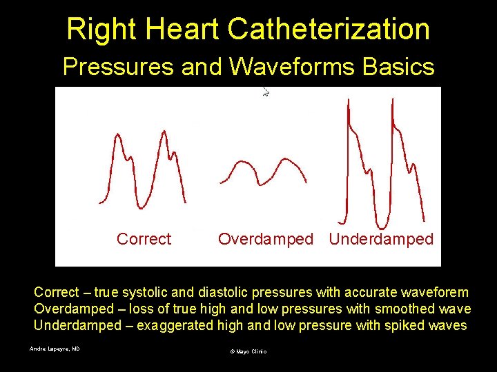 Right Heart Catheterization Pressures and Waveforms Basics Correct Overdamped Underdamped Correct – true systolic