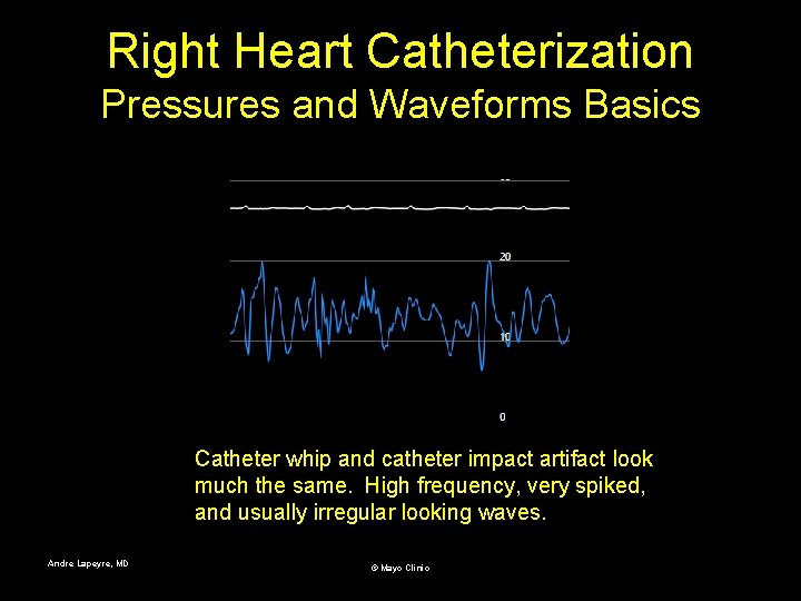 Right Heart Catheterization Pressures and Waveforms Basics Catheter whip and catheter impact artifact look