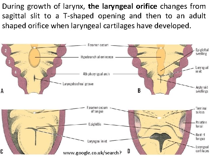 During growth of larynx, the laryngeal orifice changes from sagittal slit to a T-shaped