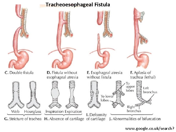 Tracheoesophageal Fistula www. google. co. uk/search? 