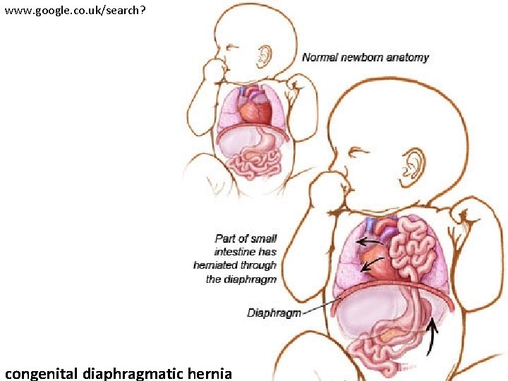 www. google. co. uk/search? congenital diaphragmatic hernia 