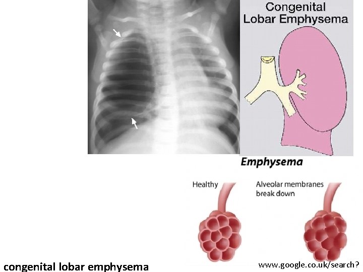 congenital lobar emphysema www. google. co. uk/search? 