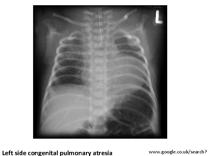 Left side congenital pulmonary atresia www. google. co. uk/search? 