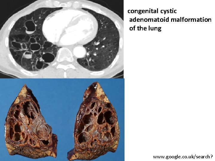 congenital cystic adenomatoid malformation of the lung www. google. co. uk/search? 