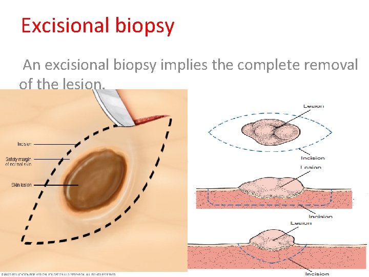 Excisional biopsy An excisional biopsy implies the complete removal of the lesion. 