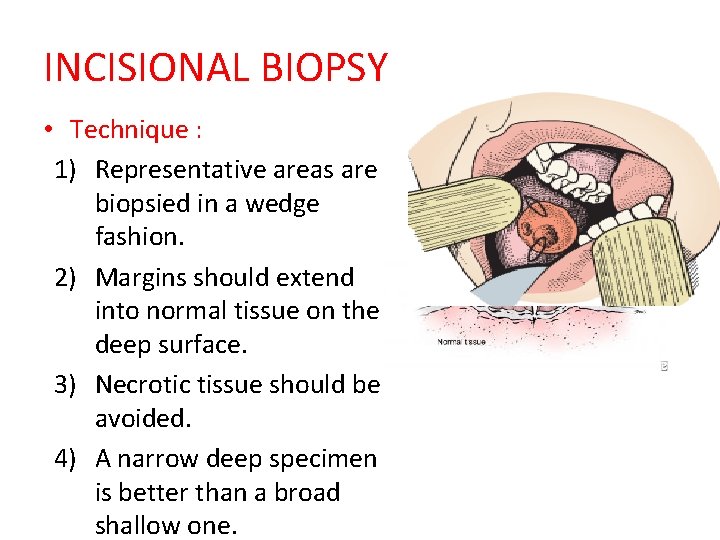 INCISIONAL BIOPSY • Technique : 1) Representative areas are biopsied in a wedge fashion.