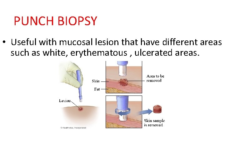 PUNCH BIOPSY • Useful with mucosal lesion that have different areas such as white,