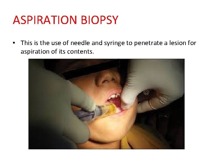 ASPIRATION BIOPSY • This is the use of needle and syringe to penetrate a