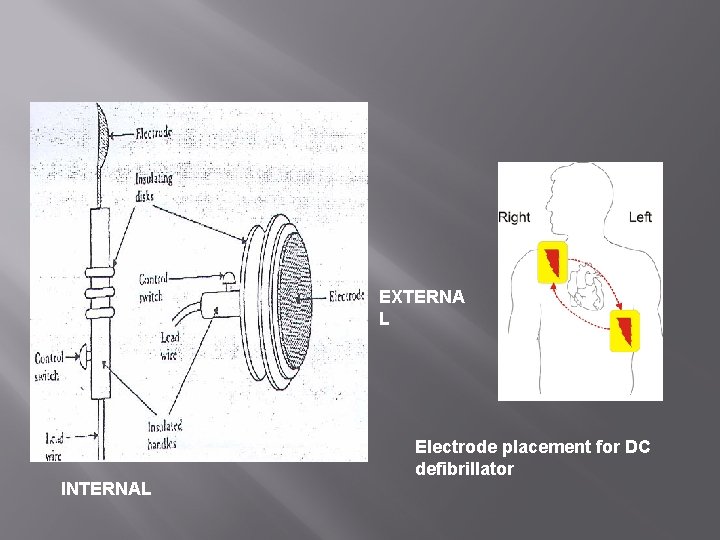 EXTERNA L Electrode placement for DC defibrillator INTERNAL 