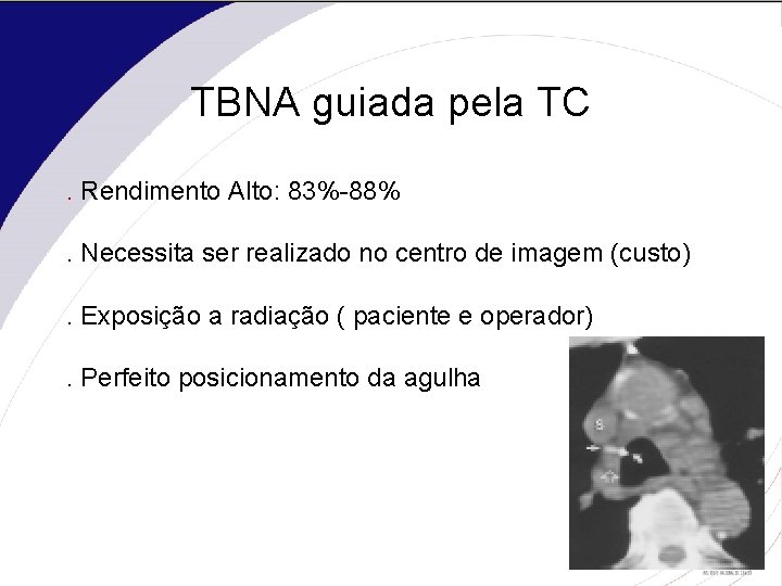 TBNA guiada pela TC. Rendimento Alto: 83%-88%. Necessita ser realizado no centro de imagem