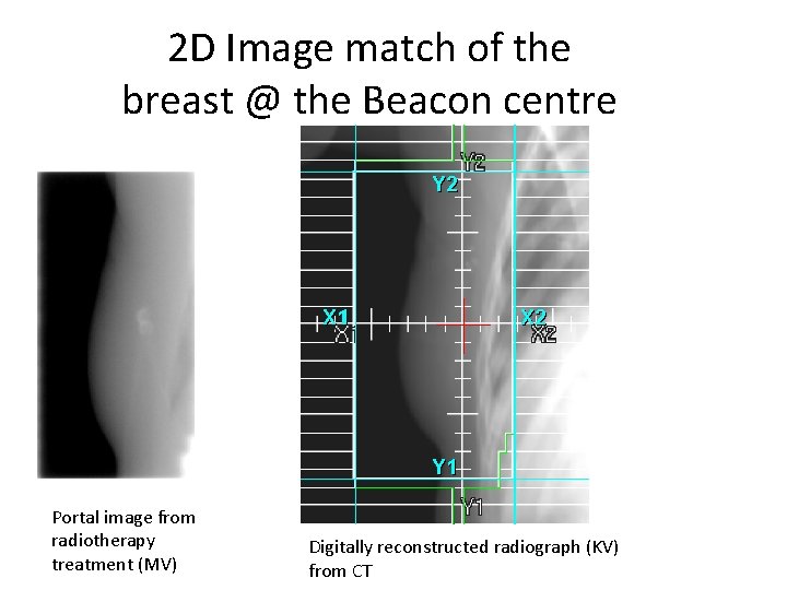2 D Image match of the breast @ the Beacon centre Portal image from