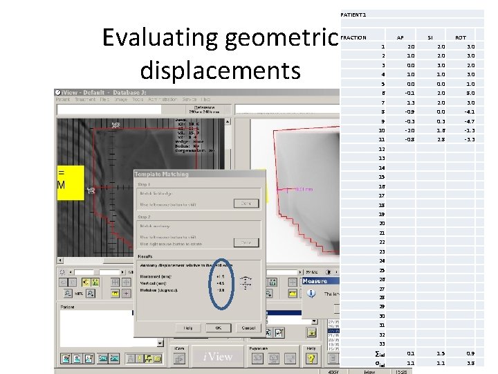 PATIENT 1 Evaluating geometric displacements FRACTION AP SI ROT 1 2 3 4 5