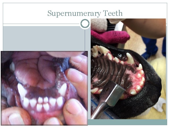 Supernumerary Teeth 
