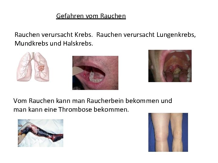 Gefahren vom Rauchen verursacht Krebs. Rauchen verursacht Lungenkrebs, Mundkrebs und Halskrebs. Vom Rauchen kann