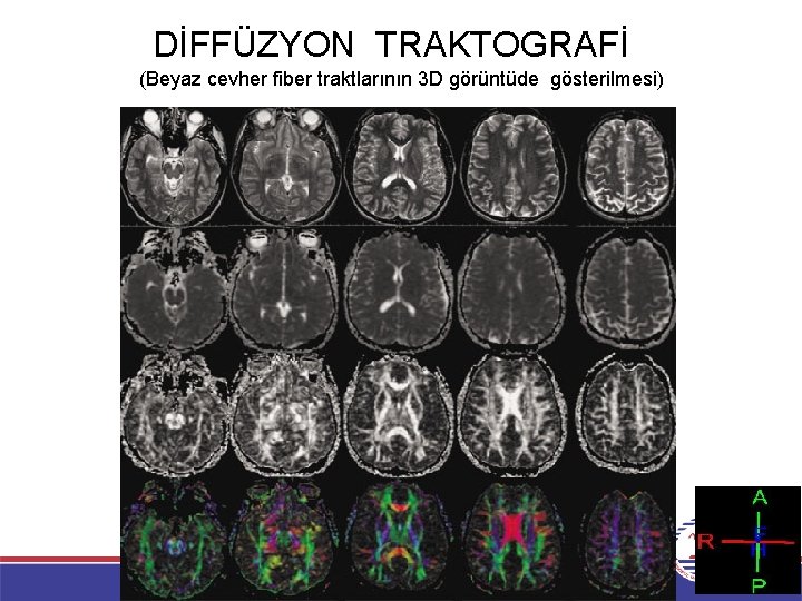 DİFFÜZYON TRAKTOGRAFİ (Beyaz cevher fiber traktlarının 3 D görüntüde gösterilmesi) 