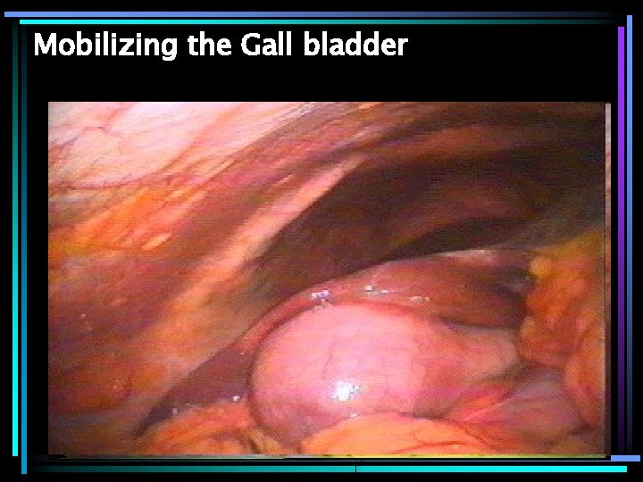 Mobilizing the Gall bladder 