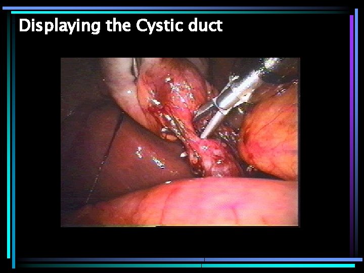 Displaying the Cystic duct 