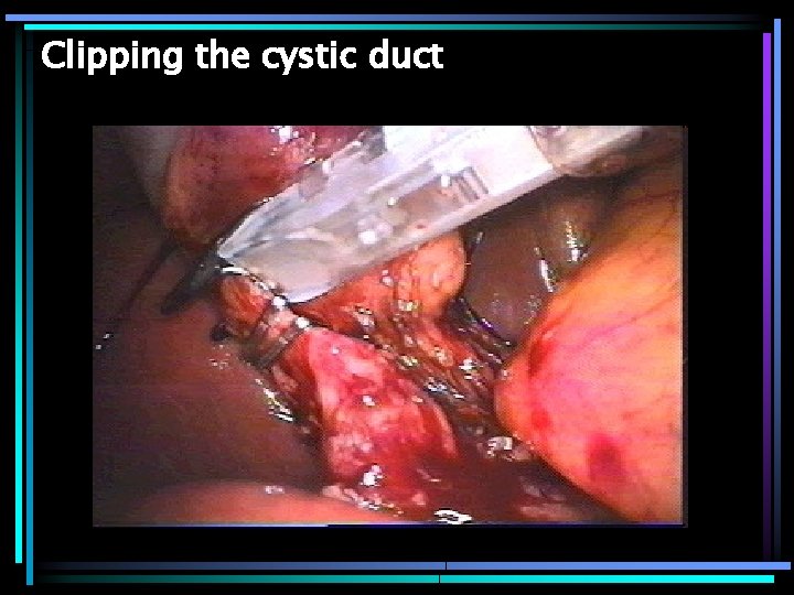 Clipping the cystic duct 