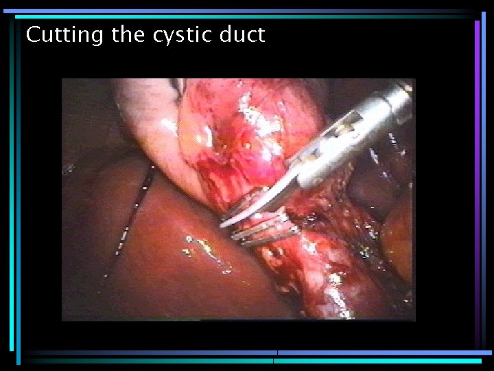 Cutting the cystic duct 