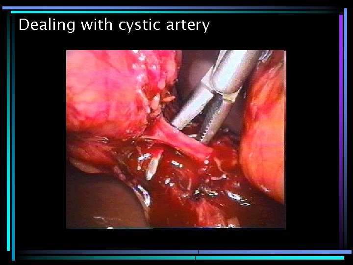 Dealing with cystic artery 