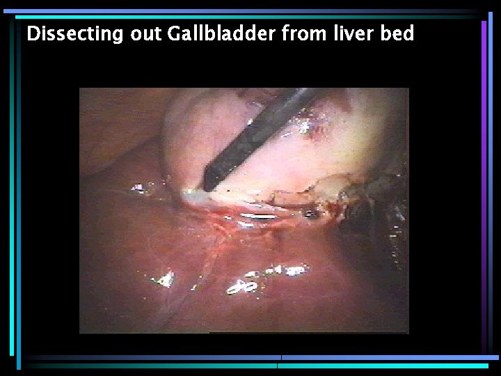 Dissecting out Gallbladder from liver bed 