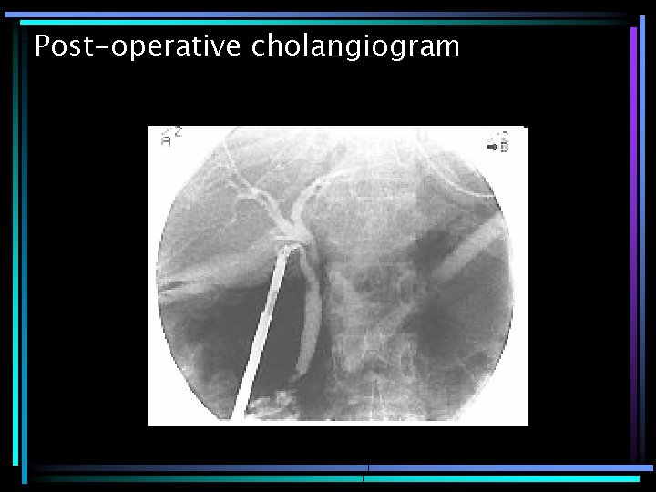 Post-operative cholangiogram 