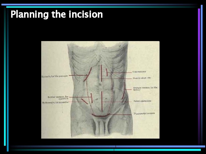 Planning the incision 