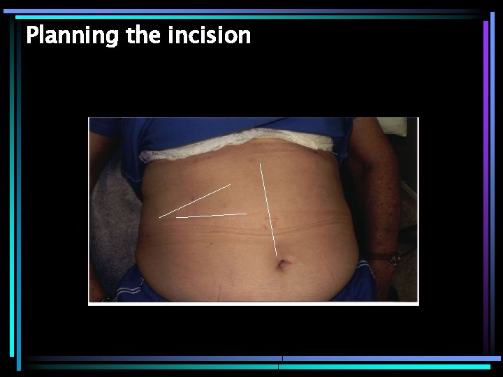 Planning the incision 