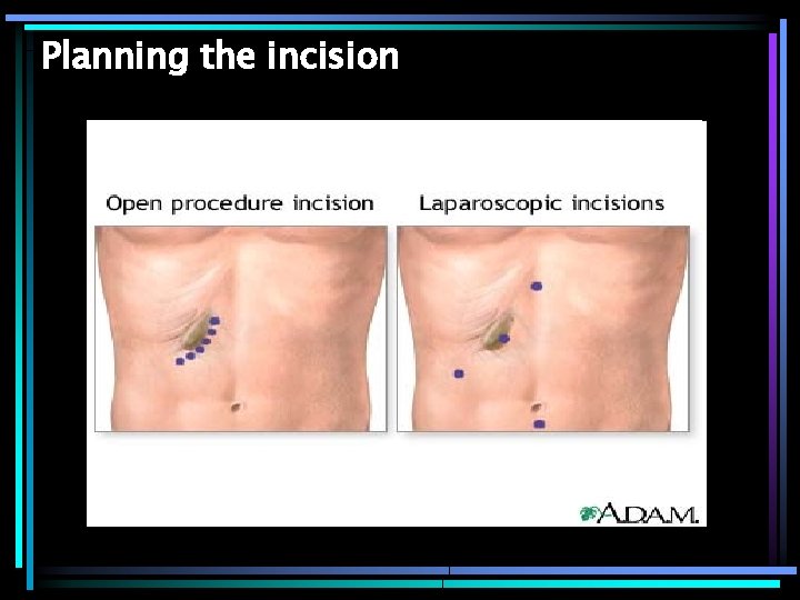 Planning the incision 