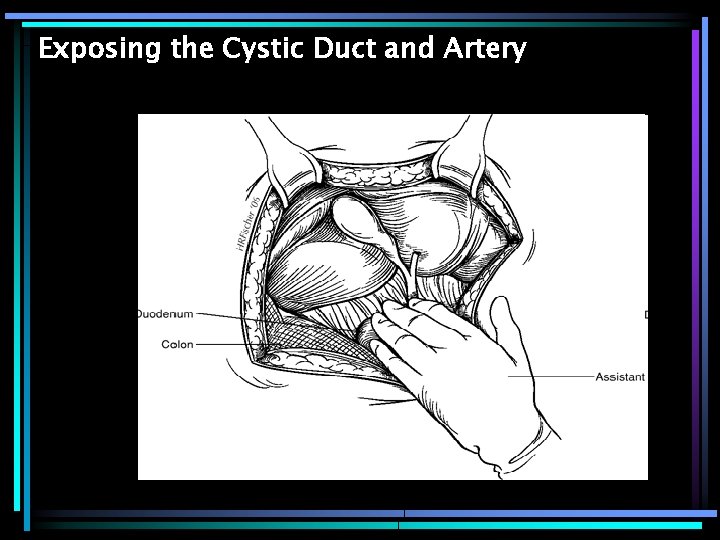Exposing the Cystic Duct and Artery 