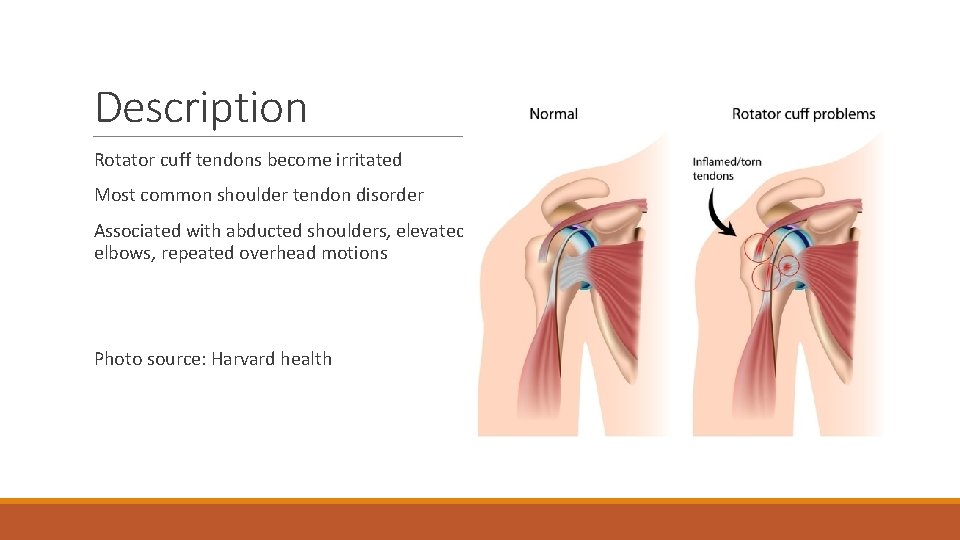 Description Rotator cuff tendons become irritated Most common shoulder tendon disorder Associated with abducted