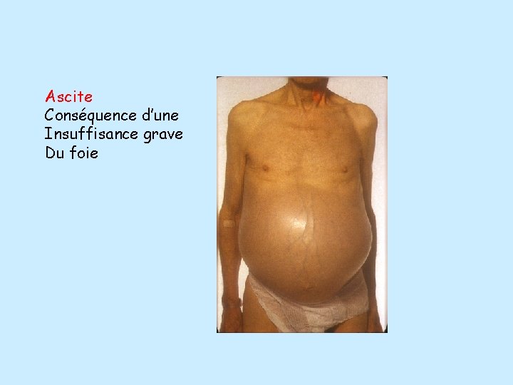 Ascite Conséquence d’une Insuffisance grave Du foie 