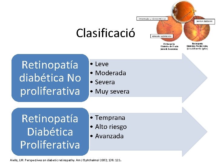 Clasificación Retinopatía diabética No proliferativa • Leve • Moderada • Severa • Muy severa