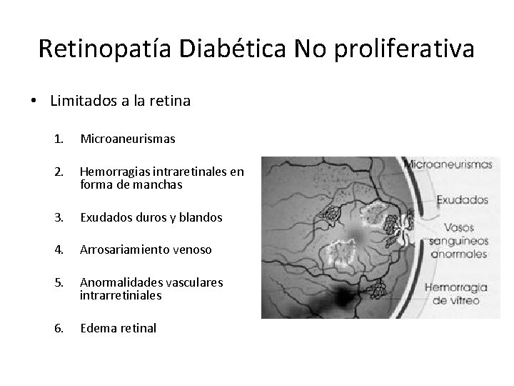 Retinopatía Diabética No proliferativa • Limitados a la retina 1. Microaneurismas 2. Hemorragias intraretinales