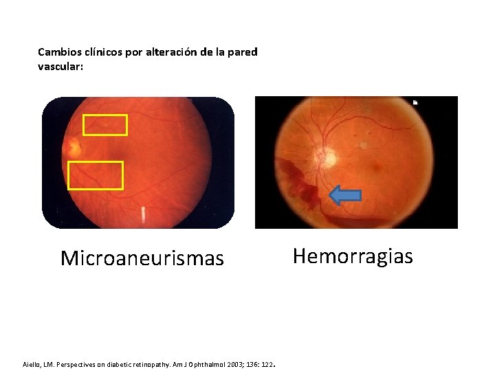 Cambios clínicos por alteración de la pared vascular: Hemorragias Microaneurismas Aiello, LM. Perspectives on