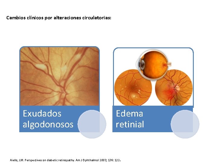 Cambios clínicos por alteraciones circulatorias: Exudados algodonosos Edema retinial Aiello, LM. Perspectives on diabetic