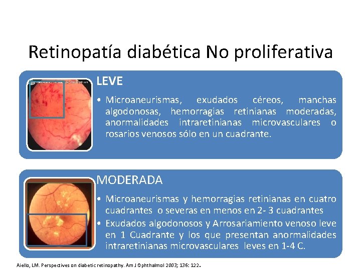 Retinopatía diabética No proliferativa LEVE • Microaneurismas, exudados céreos, manchas algodonosas, hemorragias retinianas moderadas,