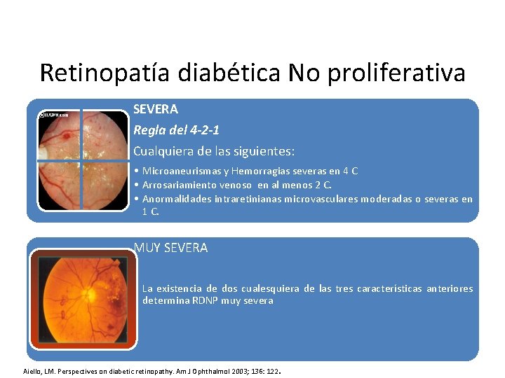 Retinopatía diabética No proliferativa SEVERA Regla del 4 -2 -1 Cualquiera de las siguientes: