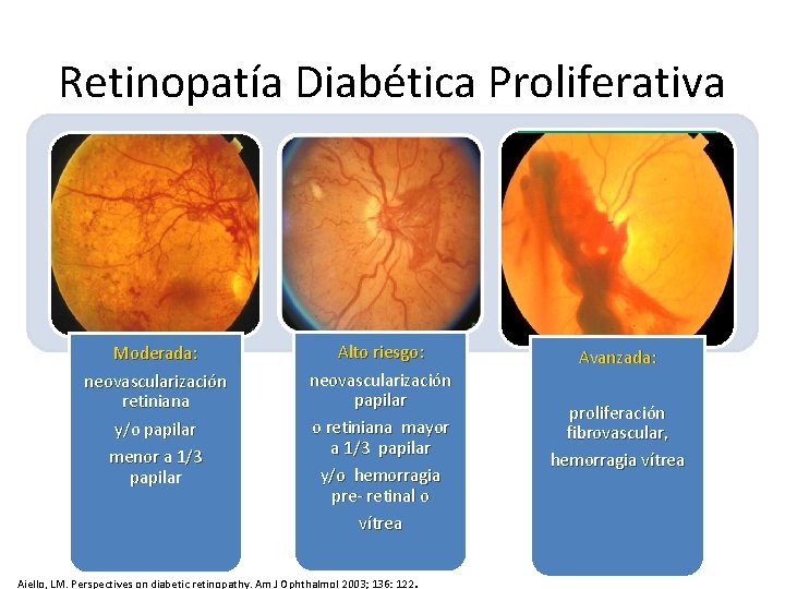 Retinopatía Diabética Proliferativa Moderada: neovascularización retiniana y/o papilar menor a 1/3 papilar Alto riesgo: