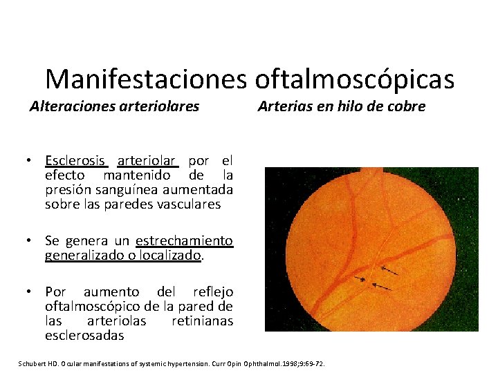 Manifestaciones oftalmoscópicas Alteraciones arteriolares Arterias en hilo de cobre • Esclerosis arteriolar por el